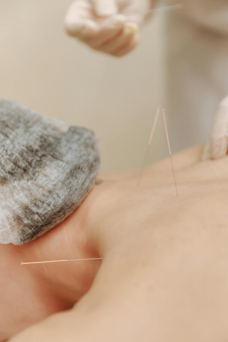 Close-up of acupuncture needles on a person's back during a treatment session.
