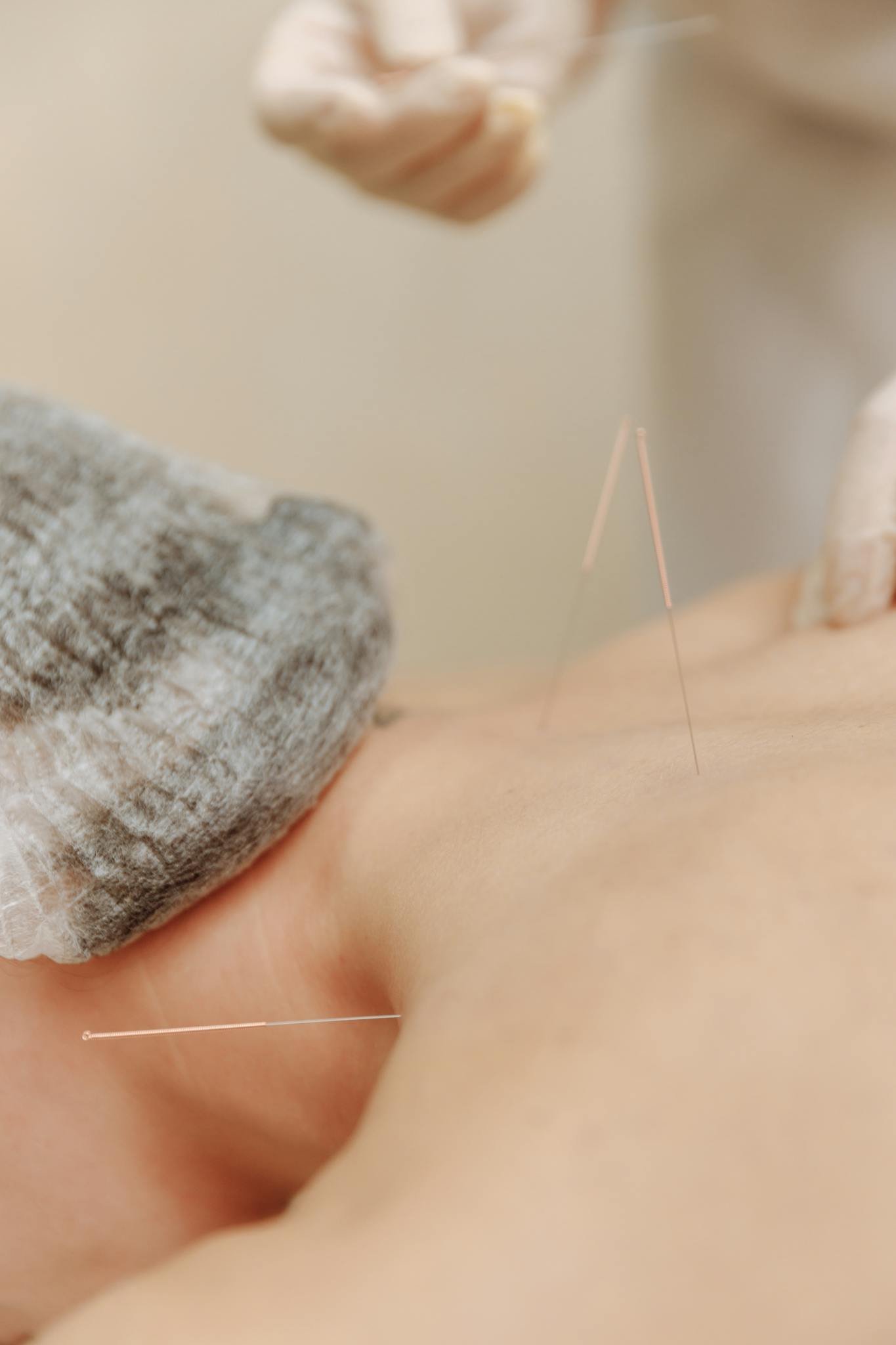Close-up of acupuncture needles on a person's back during a treatment session.