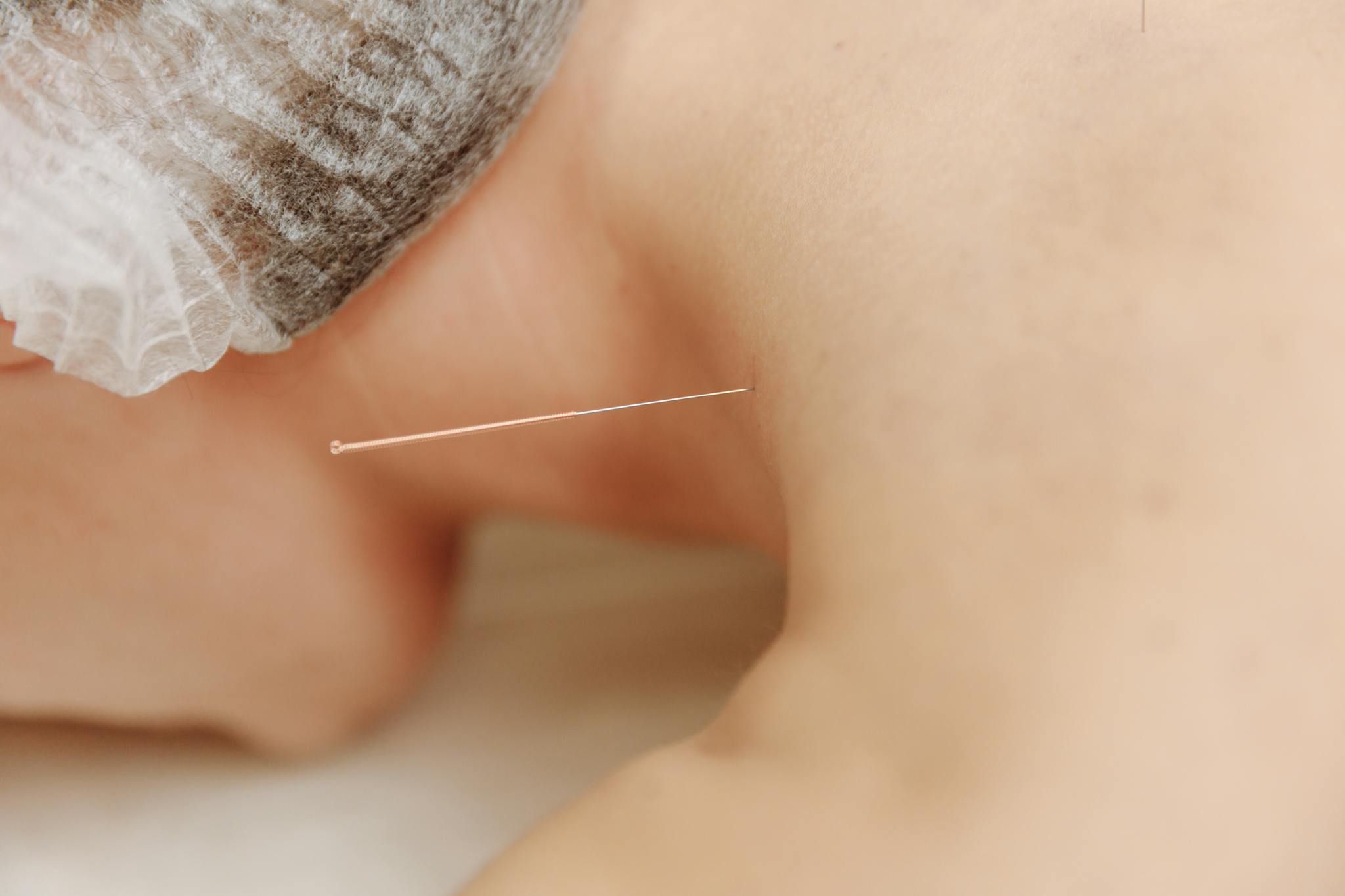 Detailed close-up image of an acupuncture needle inserted into skin, showcasing traditional Chinese medicine.