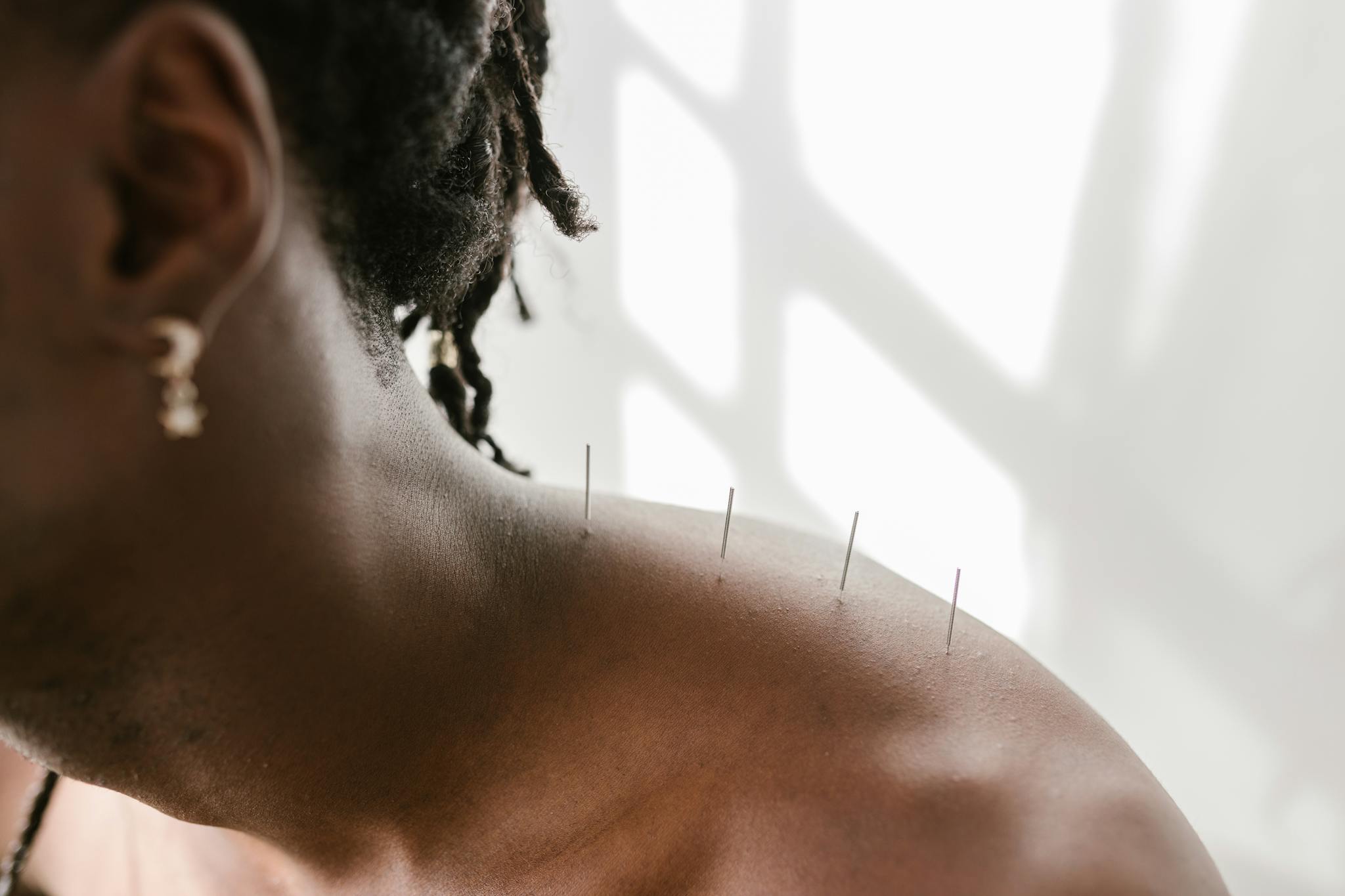 Detailed view of acupuncture needles applied to a shoulder for therapeutic treatment.